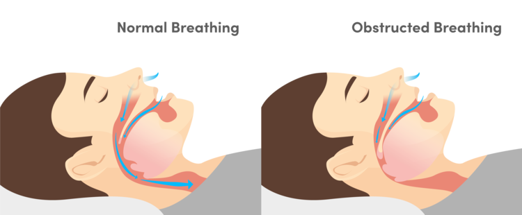 Normal Breathing / Obstructive Breathing Diagram